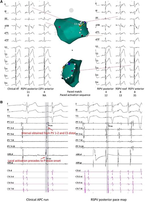 A, (Patient no 4): Comparison of the P wave morphology during FAT and ...