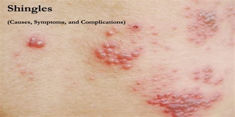 Shingles (Causes, Symptoms, and Complications) - Assignment Point