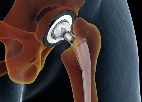 Direct Superior Hip Replacement: Approaches and Recovery