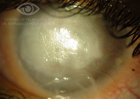 Leucoma con xerosis corneal total - Compendio de imágenes de Oftalmología