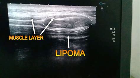 inter/intramascular lipoma ultrasound video - YouTube