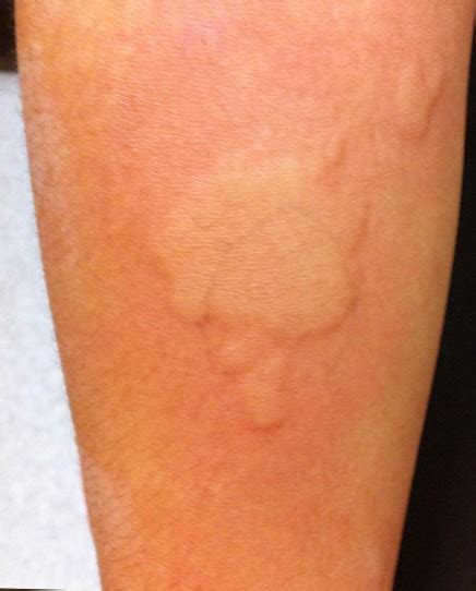 Allergic Reaction Rash - Pictures, Causes, Treatment, Symptoms