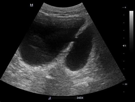 Bladder diverticulum | Radiology Case | Radiopaedia.org | Vesicula ...