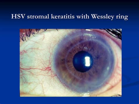 PPT - Infectious Keratitis: Differential Diagnosis & Clinical ...