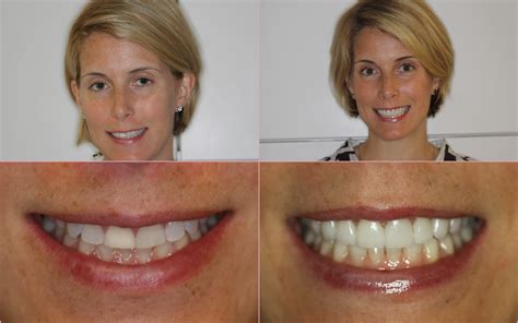 Porcelain Veneers Chicago ~ Before and After ~ July Case of the Month ...