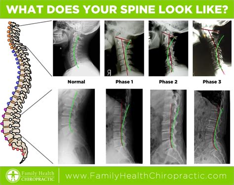 stages of spine degeneration | Family Health Chiropractic