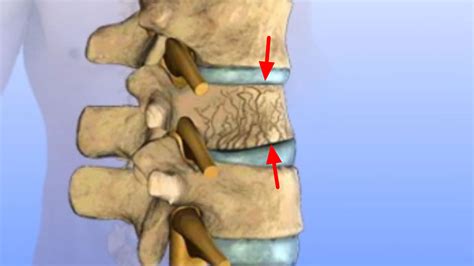 Compression fracture spine causes, symptoms, diagnosis & treatment