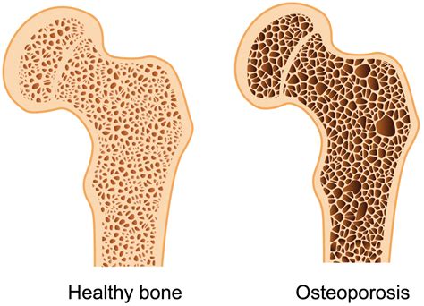 Osteoporosis « Diary of a Caribbean Med Student