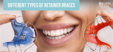 Different types of retainer braces - Best Dental Clinic in Sri Lanka ...