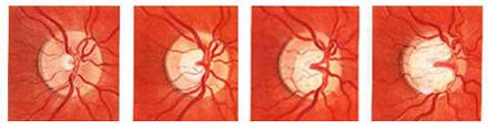 What is Glaucoma? - Glaucoma Associates of Texas