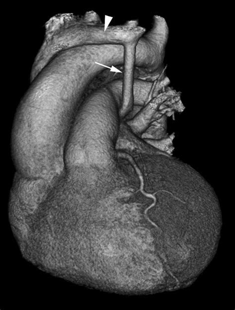 A rare case of left superior vena cava draining into left atrium ...