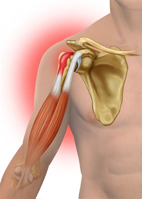 Biceps Tendinitis: Causes and Risk Factors