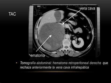 hematoma retroperitoneal