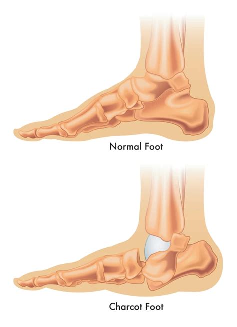 Charcot Foot: A Diabetic Foot Condition | Rocky Mountain Foot & Ankle