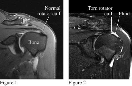 What Is The Rotator Cuff? - Centeno-Schultz Clinic