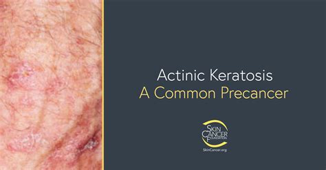 Queratosis Actínicas - The Skin Cancer Foundation