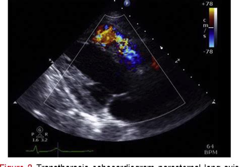 Figure 3 from Left Ventricular Aneurysm Perforating into the Right ...