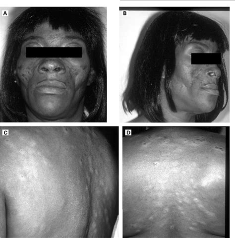 Figure 1 from Lupus erythematosus tumidus in systemic lupus ...