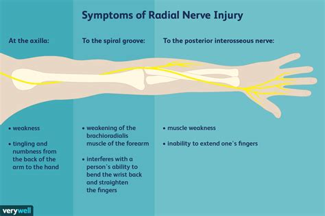 Radial Nerve Pain: Causes and Treatments