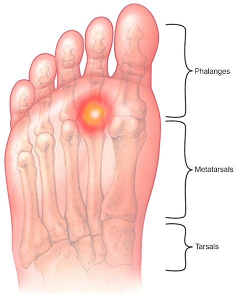 Metatarsalgia - Causes, Symptoms, Treatment, Home Remedies