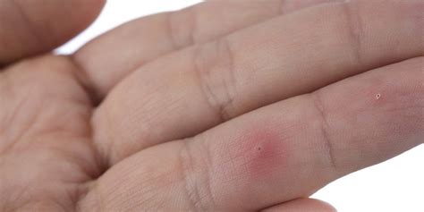 How To Remove A Splinter In One Piece | Prevention