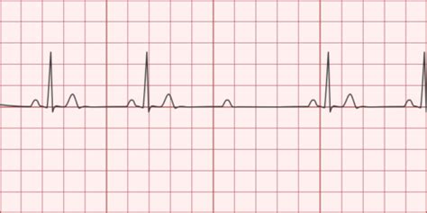 2nd Degree AV Block (Mobitz Type II) - Differential Diagnosis of