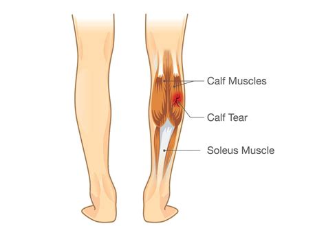 calf-muscle-tear ⋆ El Paso's Injury Doctors® 915-850-0900