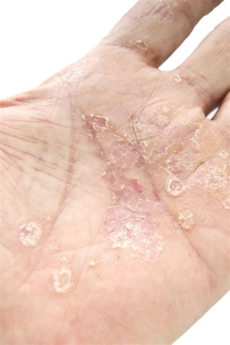 Psoriasis and cancer: Is there a link?