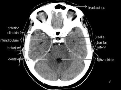 Brain CT Anatomy and Basic Interpretation Part II