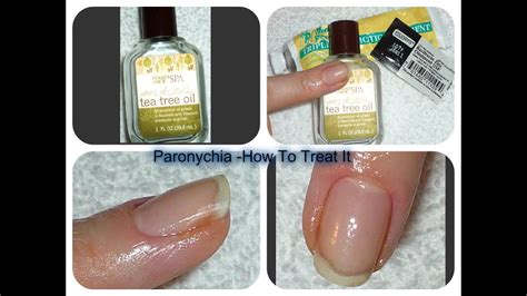 paronychia treatments - pictures, photos