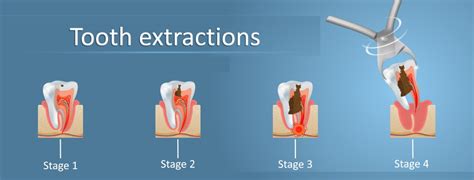 Tooth Extraction - Oral Health Center Westerville - Expert General ...