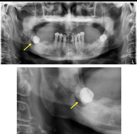 Dentigerous cyst – Radiology Cases