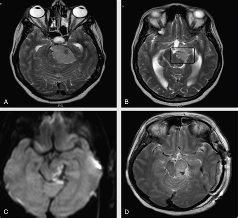 Complications in Posterior Cranial Fossa Surgery | Neupsy Key