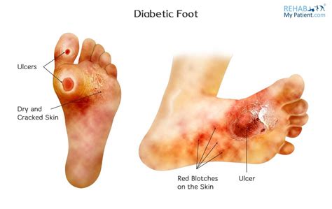 Diabetic (Charcot) Foot | Rehab My Patient