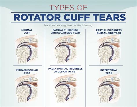 [DIAGRAM] Diagram Of Rotator Cuff Tear - MYDIAGRAM.ONLINE