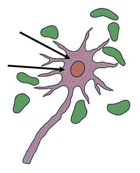 Neurofibrillary tangles - definition