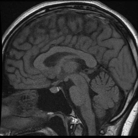 Pituitary Mri