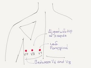 Posterior ECG Lead Placement | Resus Review