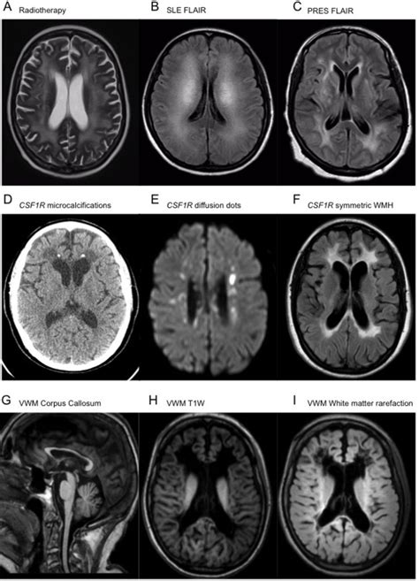 Practical approach to the diagnosis of adult-onset leukodystrophies: an ...