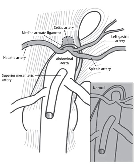 Median Arcuate Ligament Syndrome—Review of This Rare Disease | Clinical ...