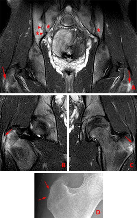 Ankylosing Spondylitis | Radsource