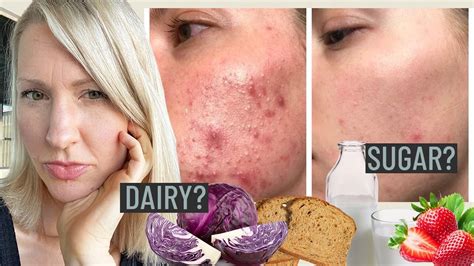 Dietitian FACT CHECKS the Hormonal Acne Diet: Is Food Causing Your Acne ...