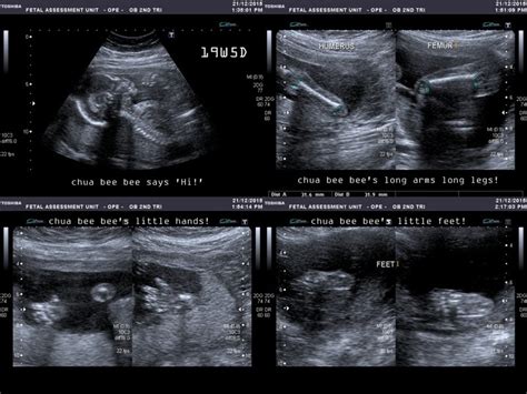 Anatomy Scan At 17 Weeks