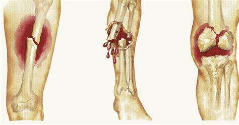 Bone Fractures - Fracture Treatment