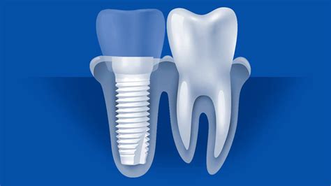 Titanium vs. Ceramic Dental Implants