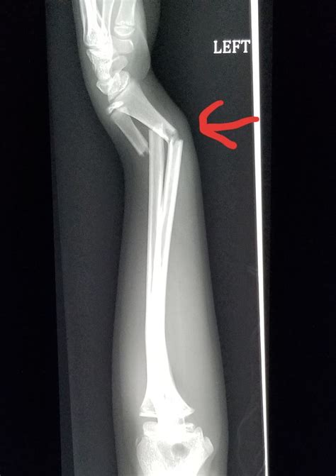 Pin on X-rays