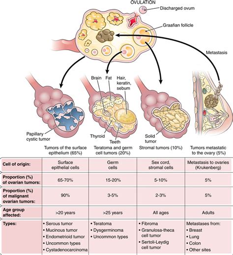 Ovarian Cancer Or Pcos Types Of Papillomavirus | Hot Sex Picture