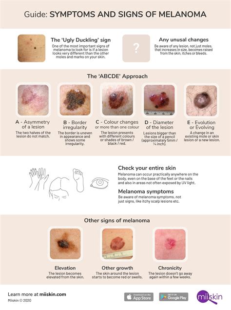 Melanoma Symptoms and Signs: Extensive Guide