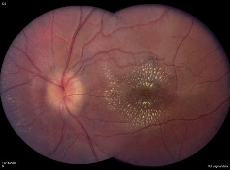 Optic Disc Edema With Macular Star, 6 Weeks After Presentation - Retina ...