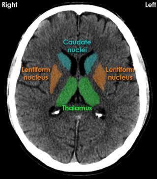 Caudate Nucleus Brain Ct - Nehan Saputra